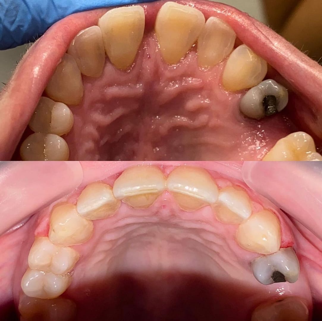 Antes y después de una ortodoncia